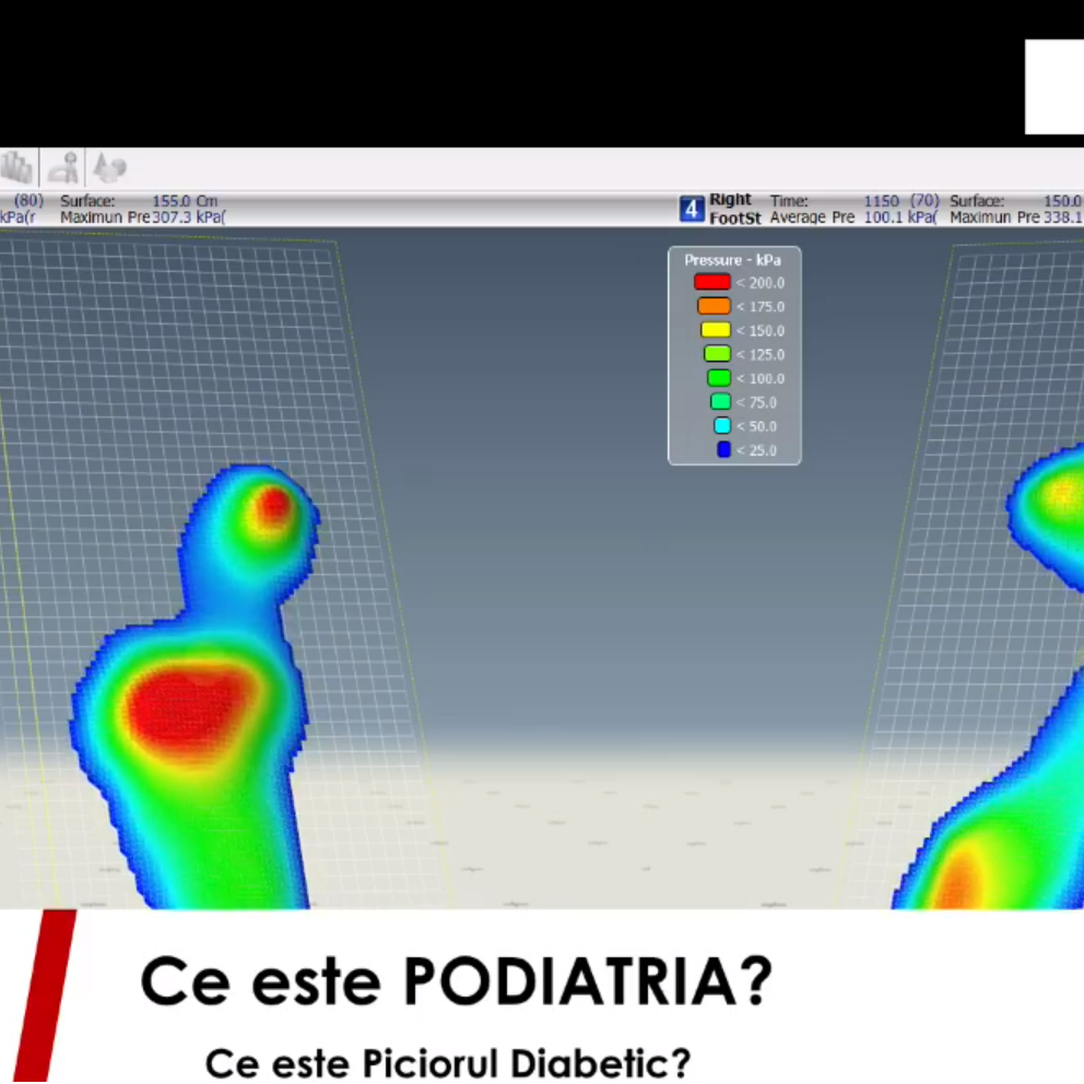 Piciorul Diabetic: GHID pentru Pacienți