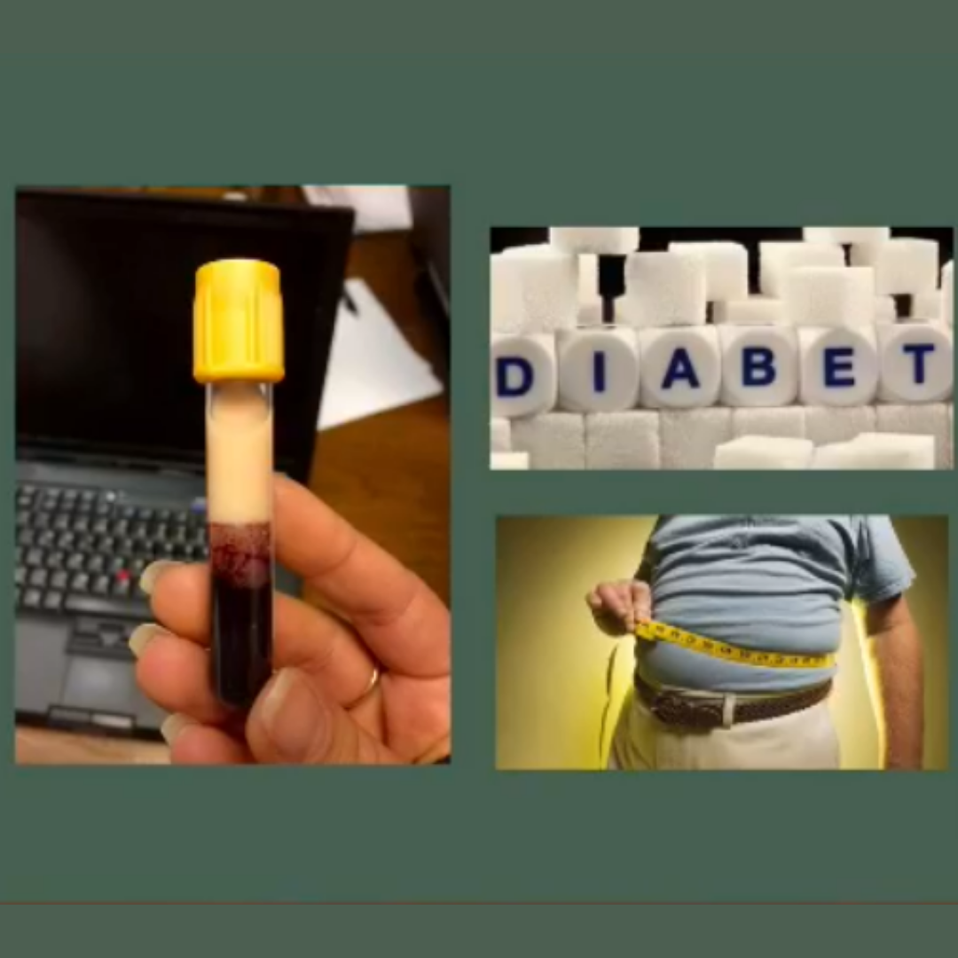 Ficatul gras în diabetul zaharat Ficatul gras în diabetul zaharat