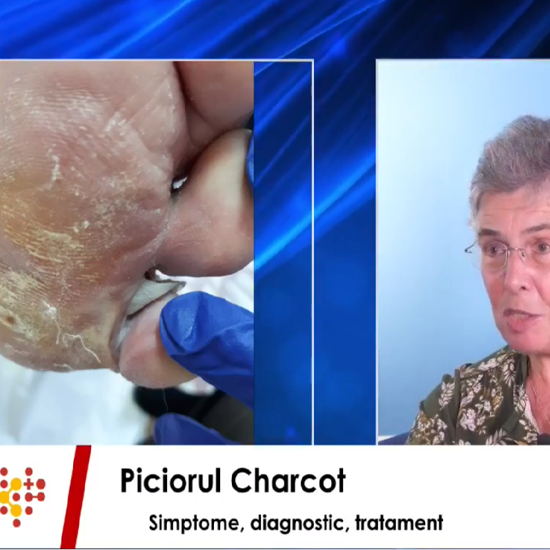 Piciorul Charcot